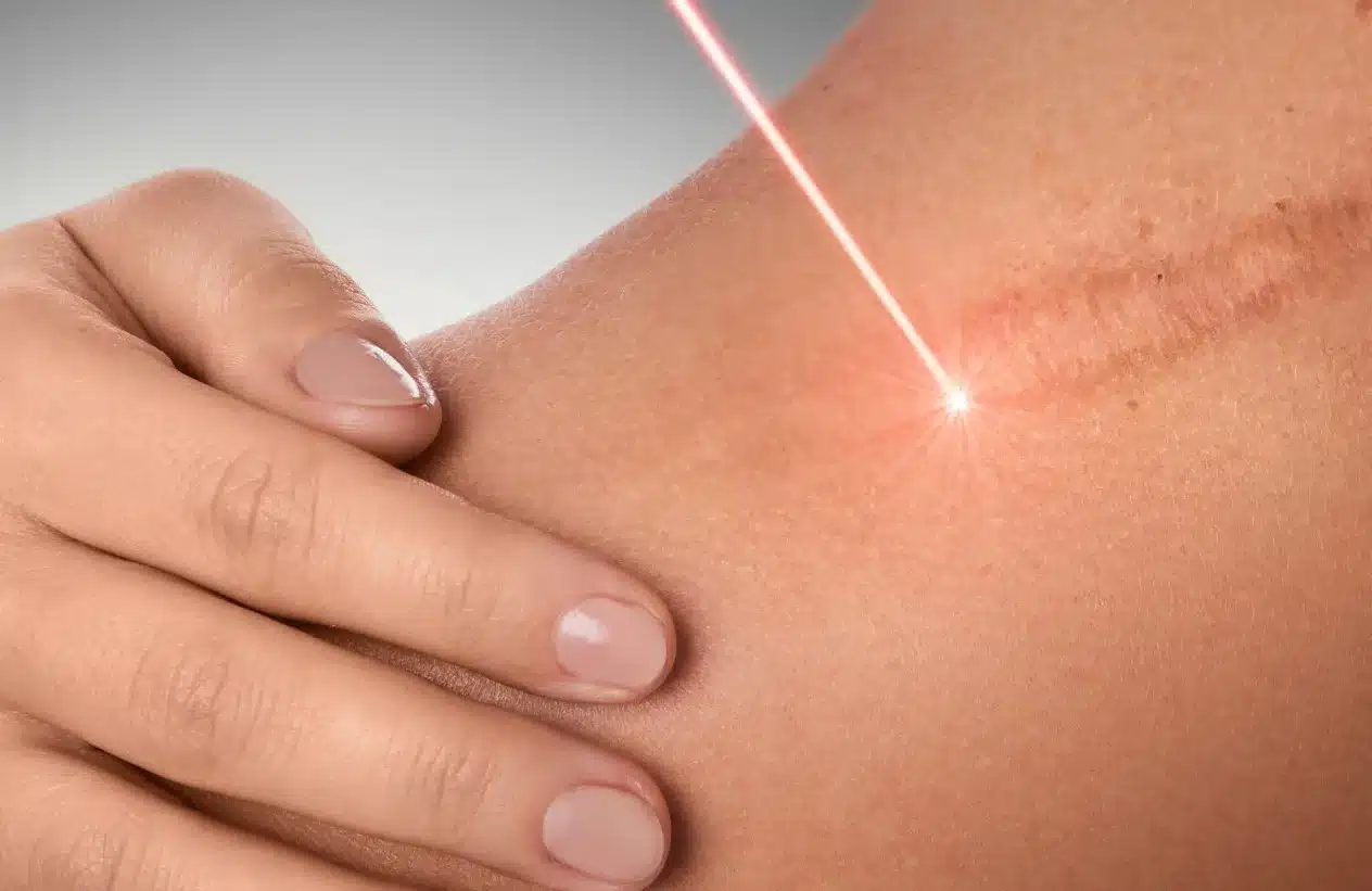 Laserterapia para cicatrização de feridas